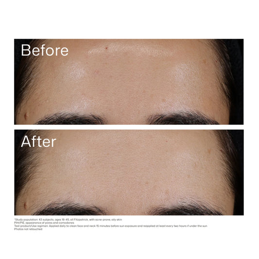EltaMD UV Clear Blemish-Prone & Oil Balancing SPF 50 Face Sunscreen
