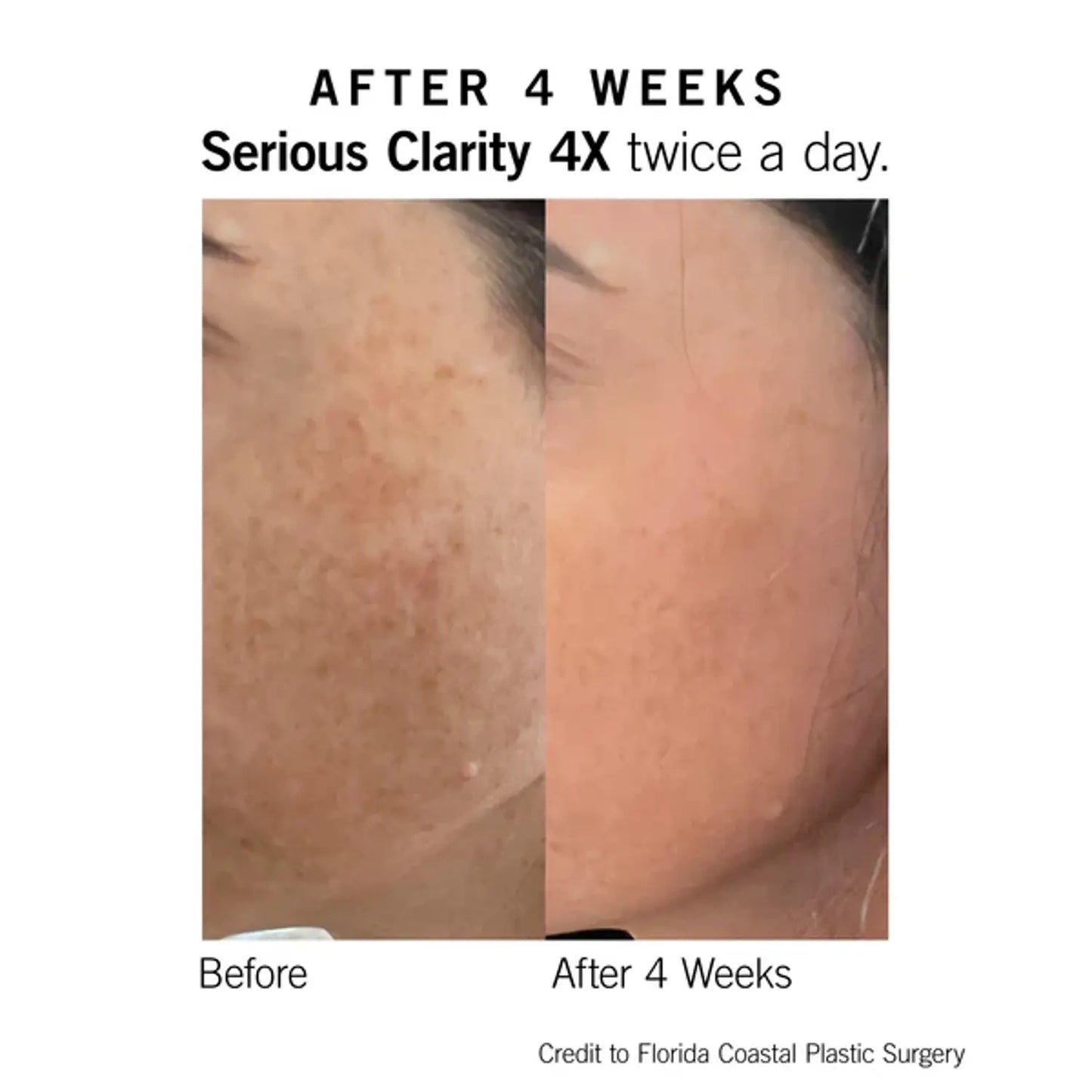 Neova Serious Clarity 4X 1 Oz-before-after
