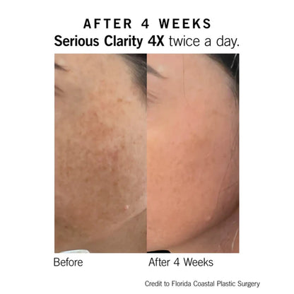 Neova Serious Clarity 4X 1 Oz-before-after