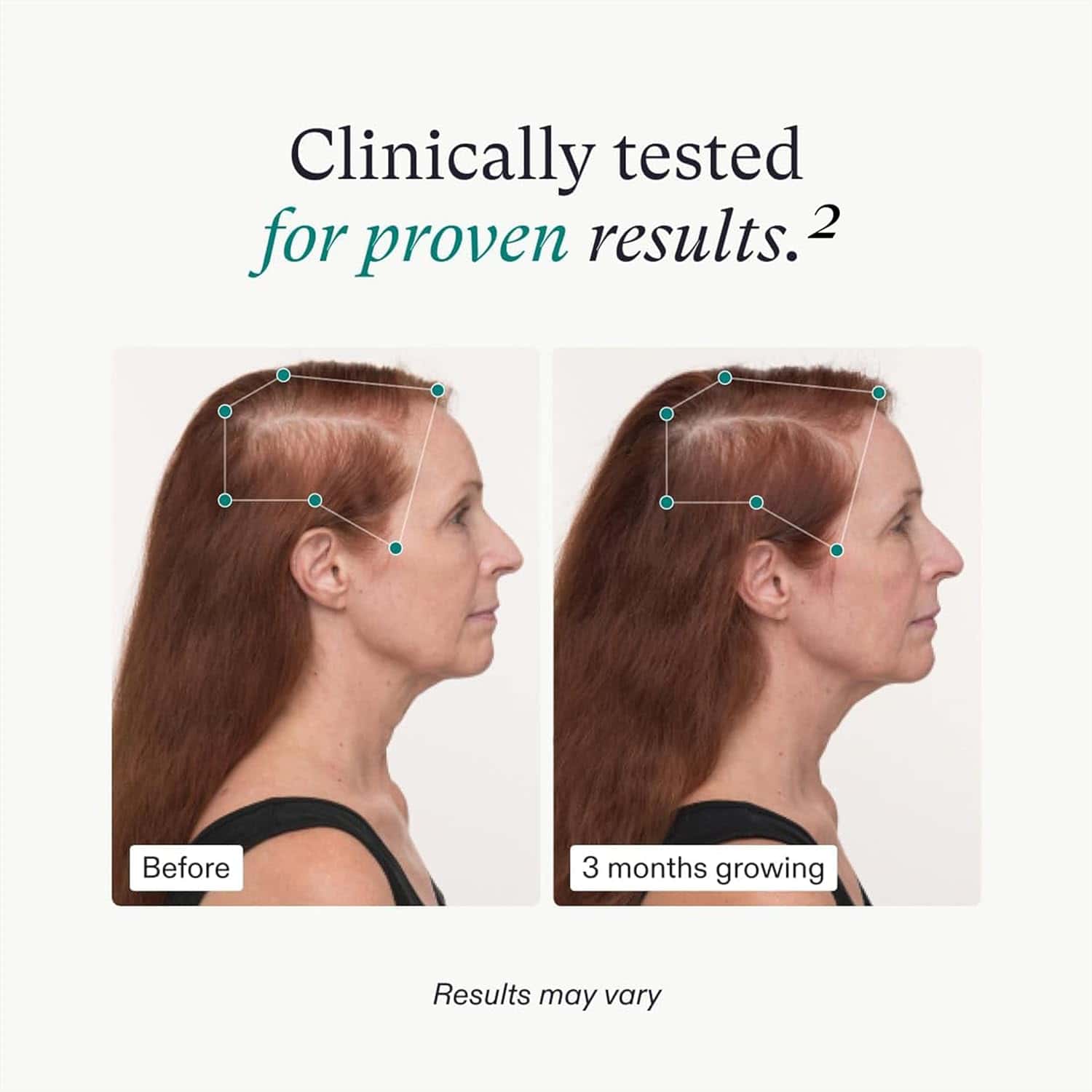 Nutrafol Women’s Balance Hair Growth Pack – supplements for balanced, healthy hair growth








